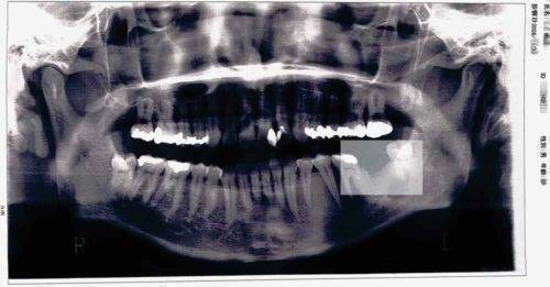 左の奥歯(7番)が欠損