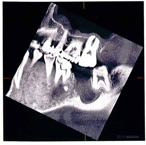 レントゲンの影がちょっとちがう・・