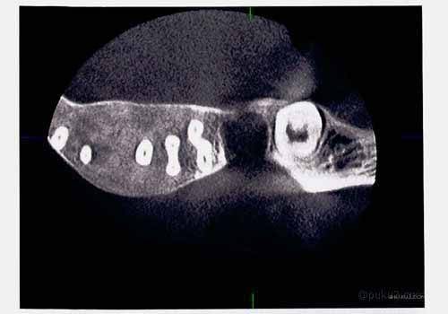 骨が消えてます・・