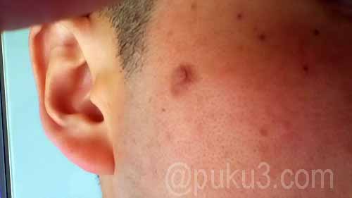 イボの除去体験記 四十路のオヤジ 顔のイボを美容皮膚科のレーザー治療でとってきた プクタロウの記録帳 Puku3 Com
