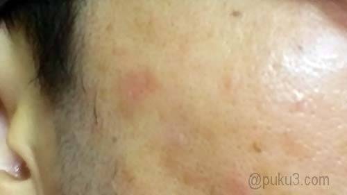 イボが消えた！！！